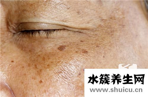 传染性软疣怎么治疗