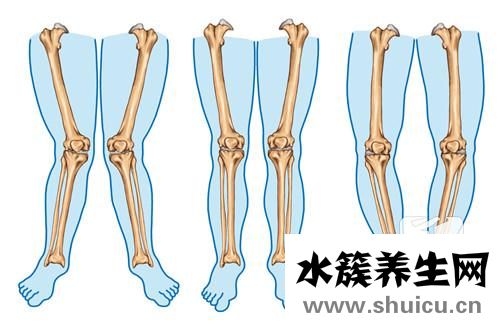 宝宝罗圈腿