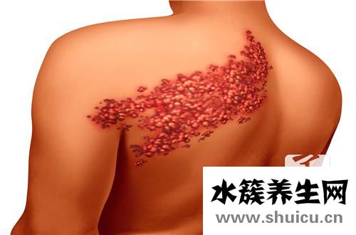 病毒性疱疹传染吗