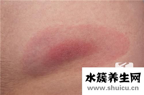 过敏性紫癜好治吗
