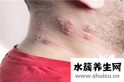 手足口病疱疹怎么治