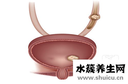 女性膀胱炎的症状