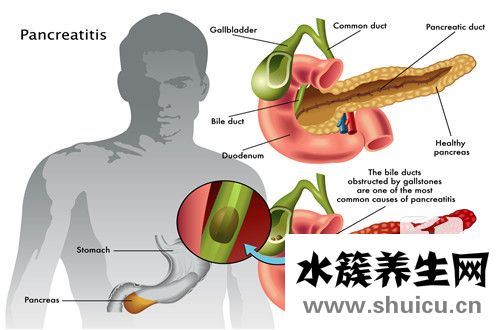 胆囊壁欠光滑