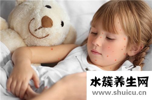过敏性荨麻疹症状