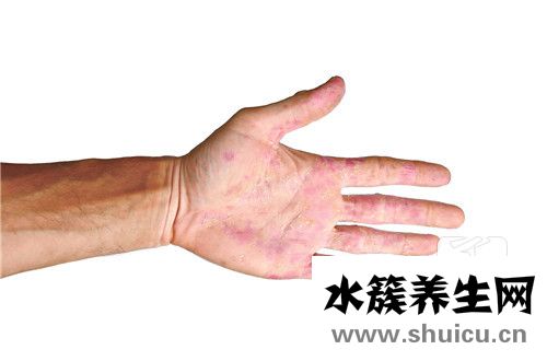什么是红斑狼疮