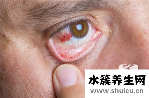 镜片选择