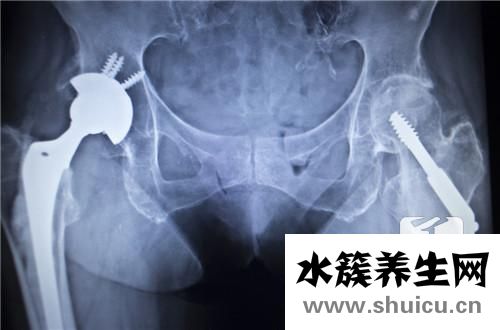 骨折恢复