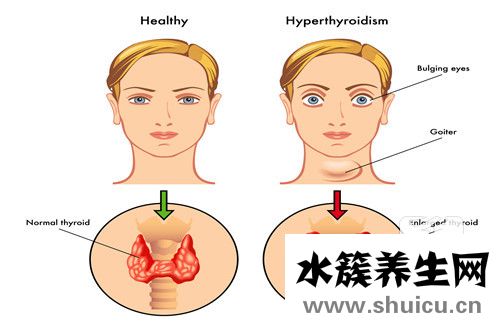 甲亢能怀孕吗