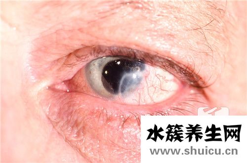 神经麻痹
