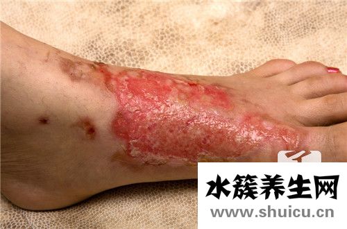 烫伤牙膏