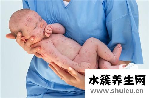 风疹是什么