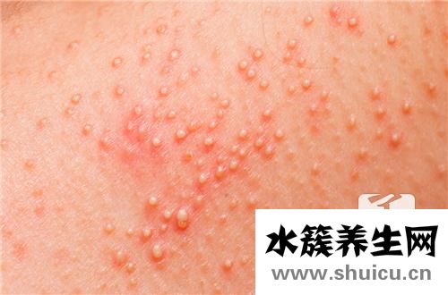 季节性湿疹