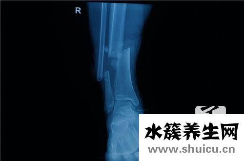 骨癌能活多久