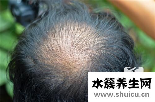 头顶头发稀少