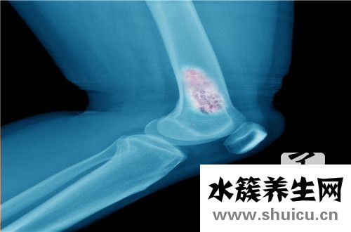 腓骨骨折