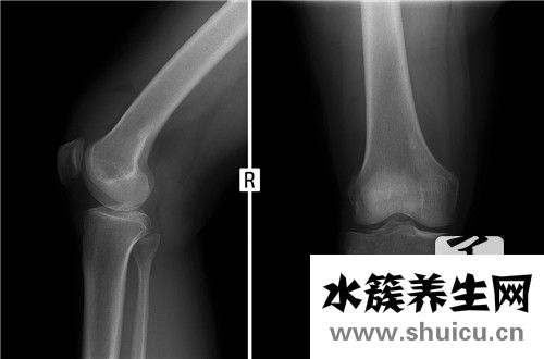 腓骨骨折