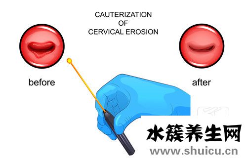 子宫附件囊肿