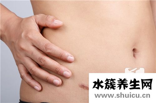切口疝