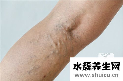 静脉曲张治疗