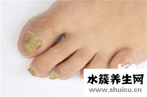 灰指甲的初期症状