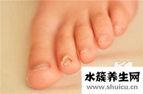 灰指甲的初期症状