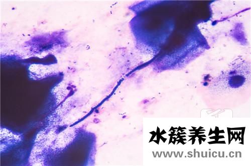 链球菌感染怎么治疗