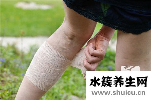 静脉曲张怎么治