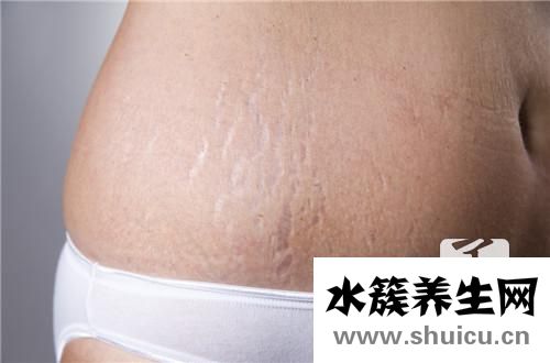妊娠斑