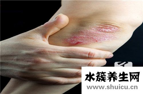 结缔组织病