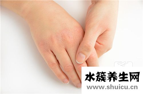 结缔组织病