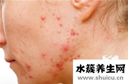 黑色素沉着