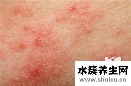 黑色素沉着
