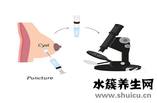 乳腺囊肿