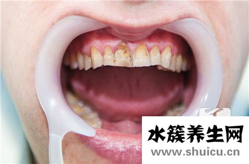 窝沟龋