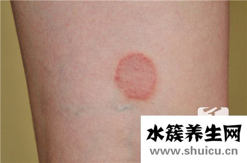身上有小红点是怎么回事