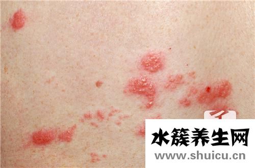 水疱