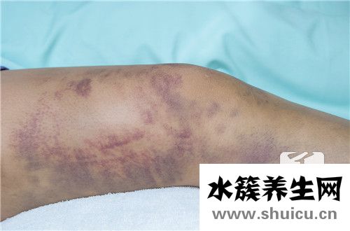 伤口化脓怎么处理