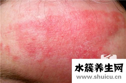 病毒性皮疹症状有哪些呢?