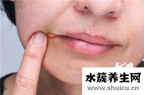 口腔内壁发白