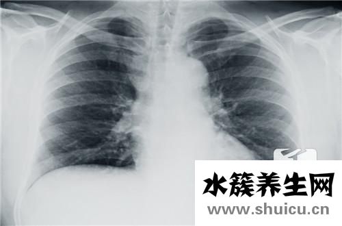 胸部x线检查