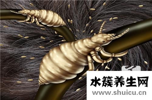 头发上长虱子怎么办