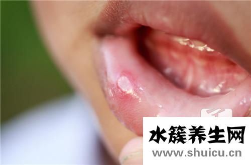 溃疡吃什么药