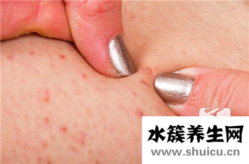治疗毛囊炎最有效的药