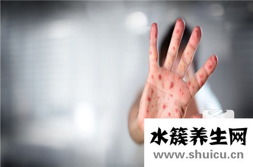 过敏性湿疹初期图片