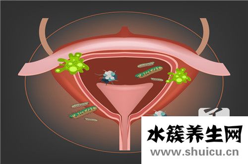 男性膀胱镜检查