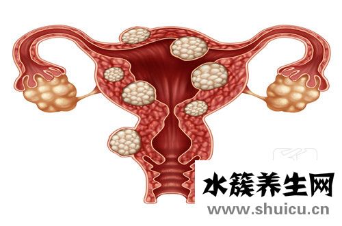 子宫癌早期能彻底根治吗？子宫癌早期还能治好吗