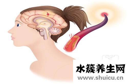 脑神经疼办