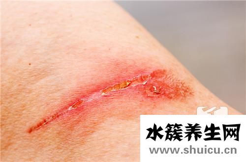 缝针疤痕能去掉吗