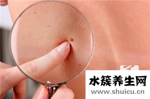 肌纤维瘤