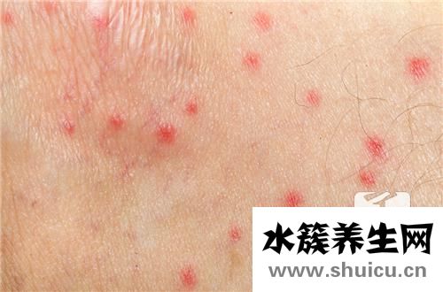 压力性紫癜有哪些危害？什么是压力性紫癜